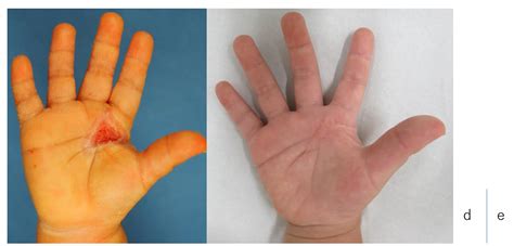 A Pilot Study to Evaluate the Minimally Invasive Burn Care for Small ...