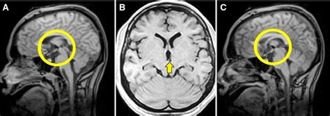 Image result for Thyroid Disorders Algorithm