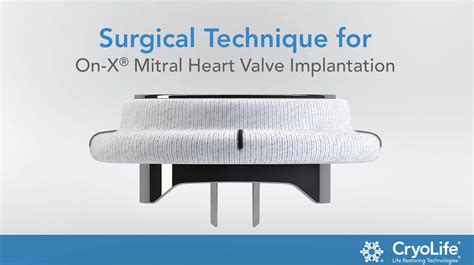 Surgical Technique for On-X® Mitral Heart Valve Implantation - CryoLife