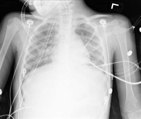 Sulcus Sign Explained 的图像结果