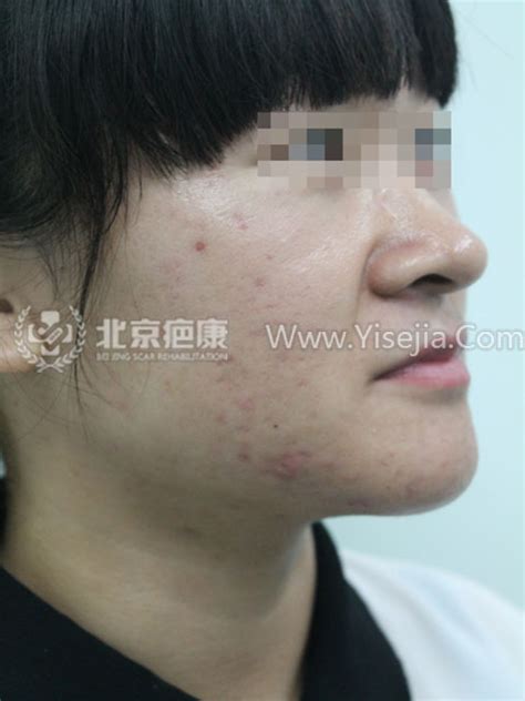 面部青春痘治疗案例 - 北京疤康
