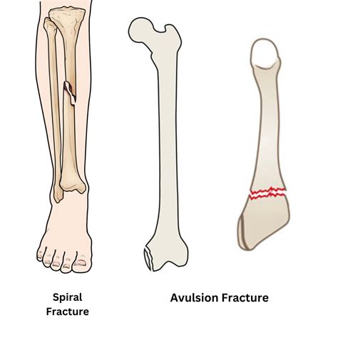 What Is A Spiral Bone Fracture at Isabelle Bloch blog