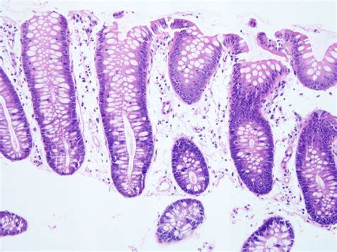 Pathology Outlines - Common variable immunodeficiency (CVID)