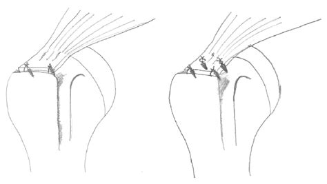 Image result for Single Row Rotator Cuff Repair