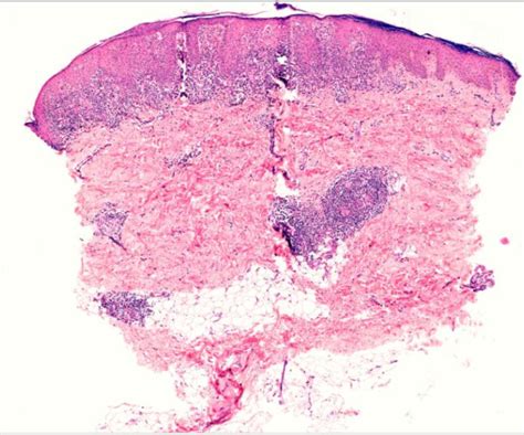Dermatopathology Society of India: Image of the Month