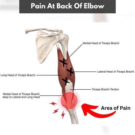 Elbow Tendonitis The New York Times > Health > Image > Tendonitis