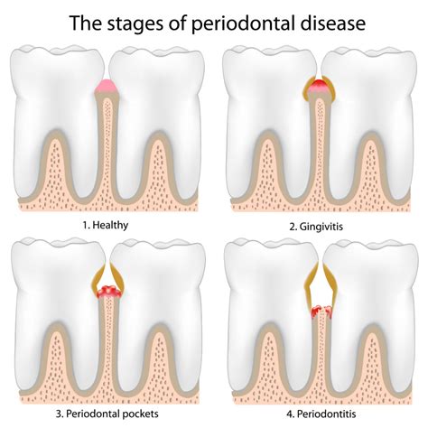 What Are the Signs (and Treatments) For Gum Disease In Arlington Heights?