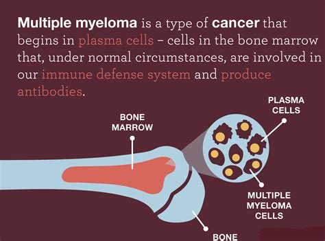Multiple myeloma,what to know?