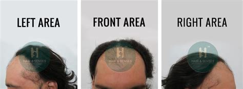 Hair Transplant Case Study with 4239 Grafts