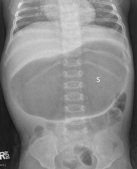 Imaging Features of Neonatal Bowel Obstruction | RadioGraphics