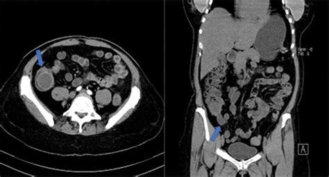Image result for Normal Appendix Coronal