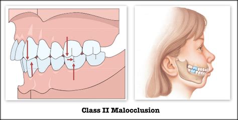Class 2 malocclusion