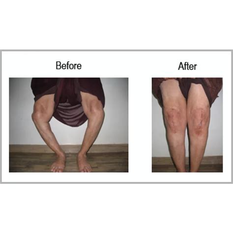 Osteoarthritis With Large Bony Defect - Dr Samir Nanavati