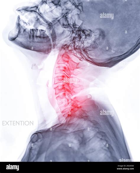 X-ray C-spine or x-ray image of Cervical spine Extension viewfor diagnostic intervertebral disc ...