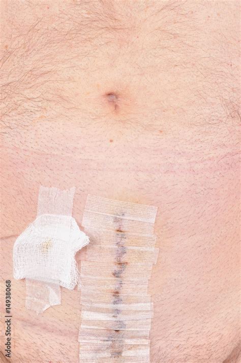 Actual Prostate Surgery 的图像结果