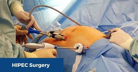 Image result for HIPEC Surgery