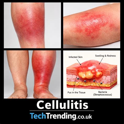 Cellulitis: Causes, Types, Symptoms, Treatment, and Prevention - Tech Trending