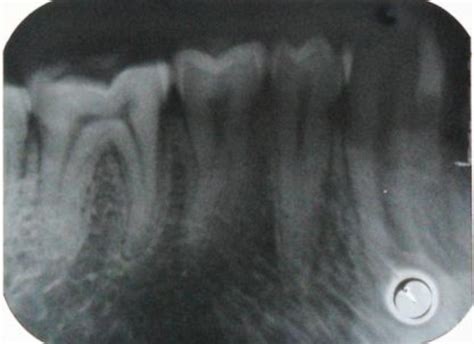 Image result for Contralateral Side