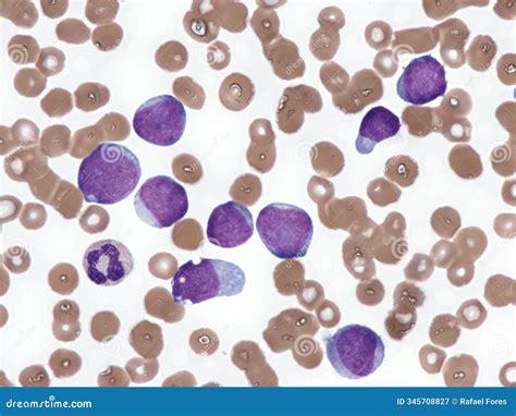Leucemia Mieloide Aguda. Sangre Periférica. Imagen de archivo - Imagen ...