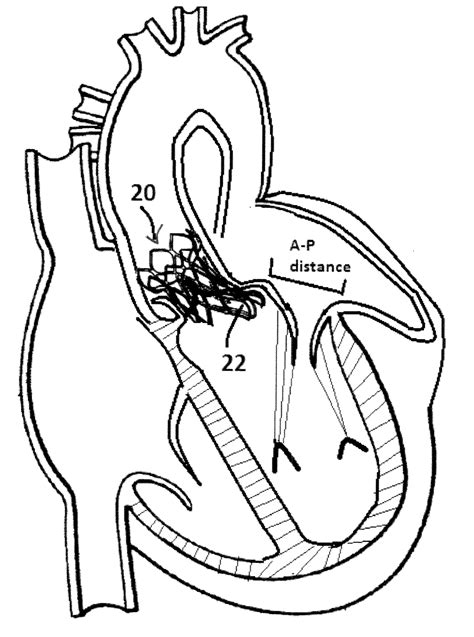 Method and Design for a Mitral Regurgitation Treatment Device - Eureka ...
