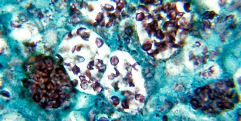 What Is Darling Disease? Know Symptoms, Causes, Risk Factors And ...