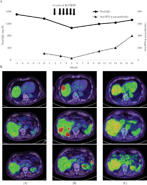 Figure 1 from R-CHOP Chemotherapy for Disseminated Mycobacterium avium Complex Disease due to ...
