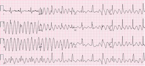 Torsades de Pointes in a Stable Patient With Parkinson Disease—Mimic or Life-Threatening ...