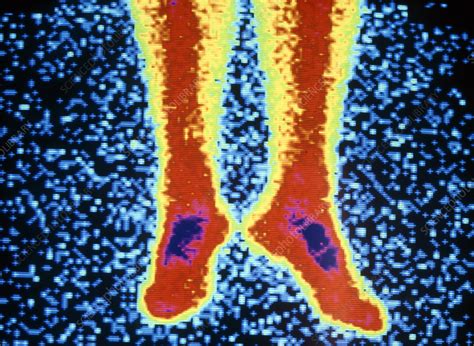 Coloured radionuclide bone scan of lower legs - Stock Image - P830/0027 - Science Photo Library