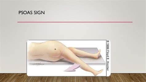 Image result for Psoas Sign