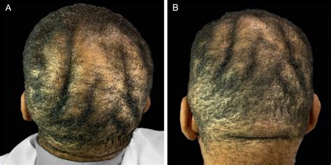 Cutis verticis gyrata: a cutaneous finding in acromegaly | Anais ...