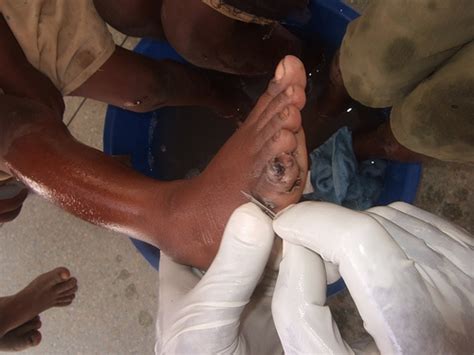 Image result for Jigger Bug Parasite