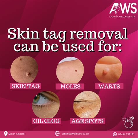 Skin Tag Removal - Amanda Wellness Spa