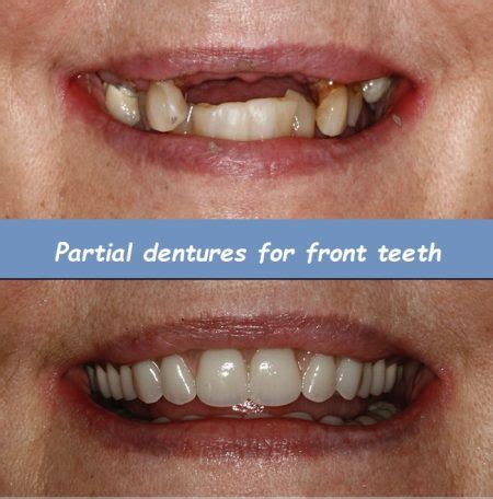 Image result for Front Teeth Partials Options