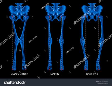 Image result for Leg Alignment