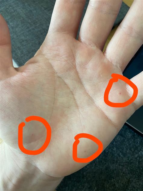 What are these little red dots on my hand? : r/DiagnoseMe