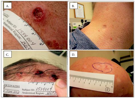 Sustained Suppression of Gorlin Syndrome-Associated Basal Cell ...