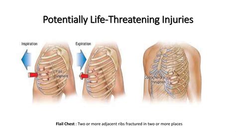 Approach to patients with polytrauma | PPTX