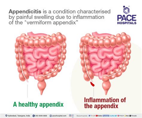 Image result for Different Types of Appendicitis