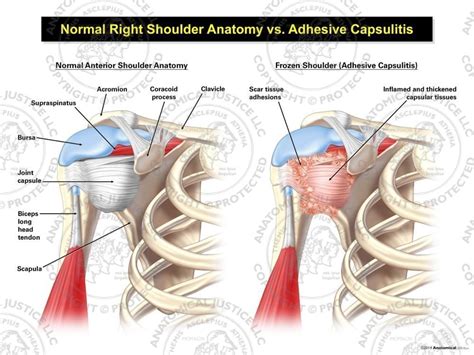 Normal Right Shoulder Anatomy vs. Adhesive Capsulitis