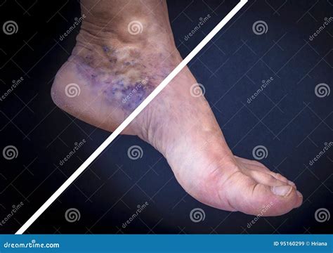 Feet Edema Varicose at Indiana Schneider blog