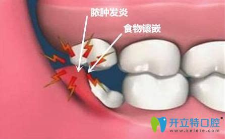 不要再纠结智齿冠周炎能自愈吗?教你三个方法轻松治疗疼痛 - 牙科治疗 - 开立特口腔