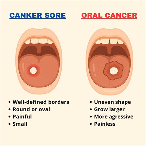 When a Canker Sore Is Actually Oral Cancer: How to Know