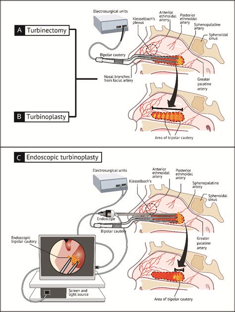 Inferior Turbinate Reduction