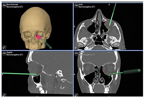 Patient Specific Implants for Orbital Reconstruction in the Treatment of Silent Sinus Syndrome ...