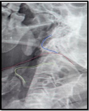 Image result for Functionality of the Styloid Process of Temporal Lobe