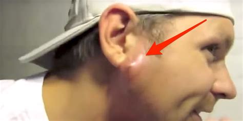 Image result for Worst Exploding Pimple