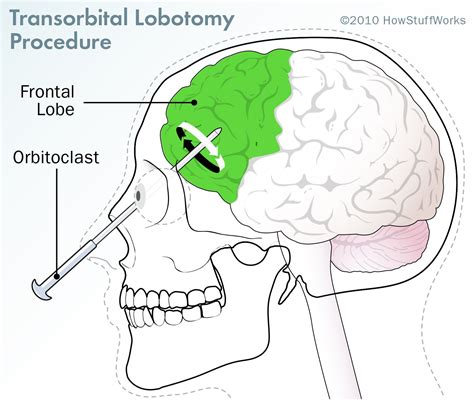 What Happens When Someone Is Lobotomized