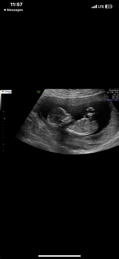 14.5 week ultrasound! | BabyCenter