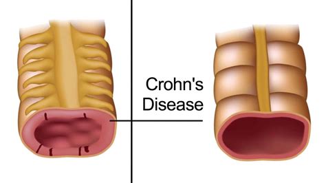 5 Early Warning Signs of Crohn's Disease