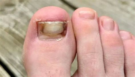 Curled Toenails Fix 的图像结果